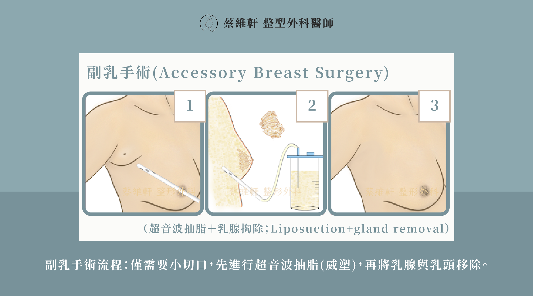 網站圖 副乳微創手術P1 V1