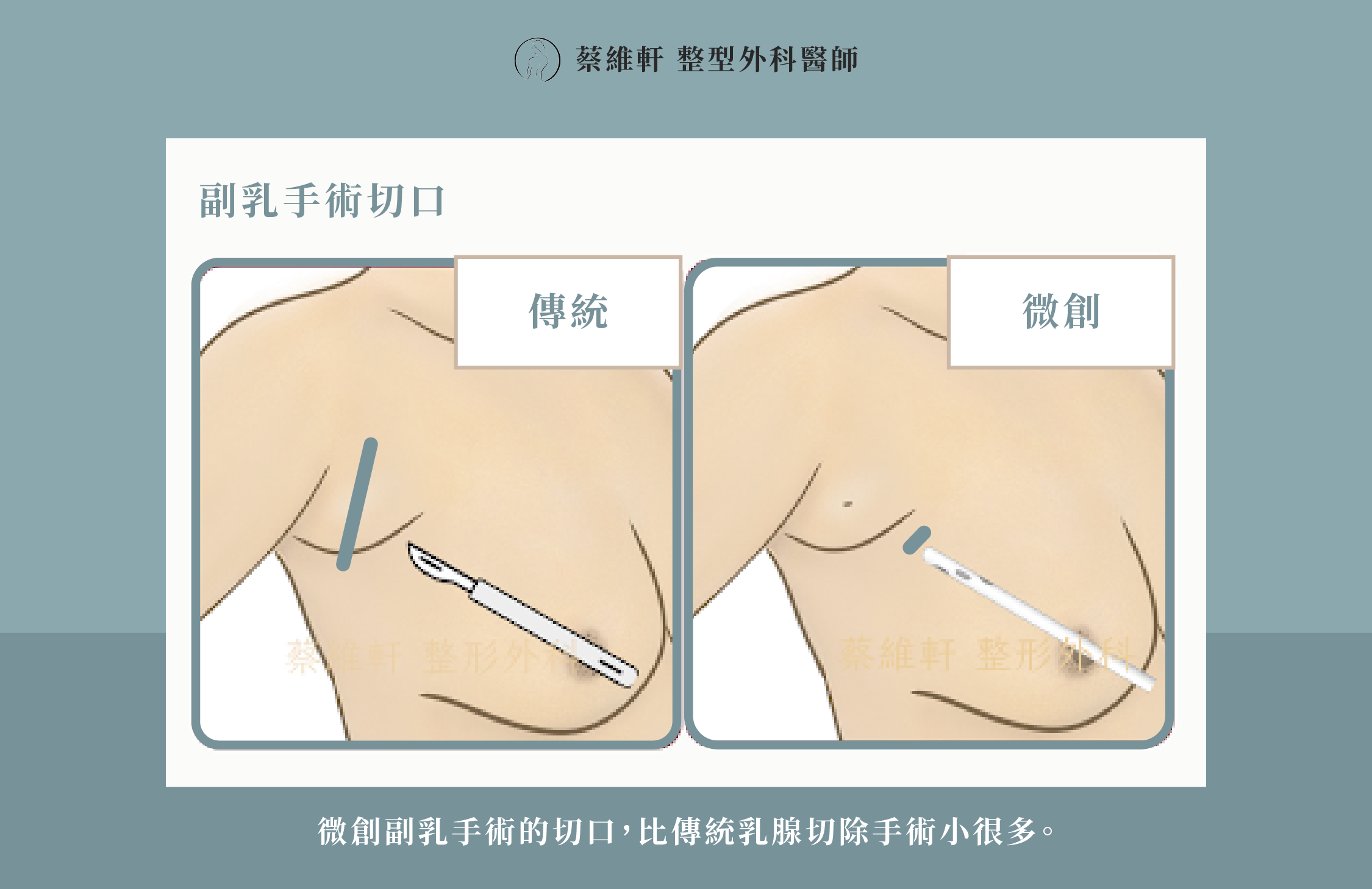 網站圖 副乳微創手術P3 V1