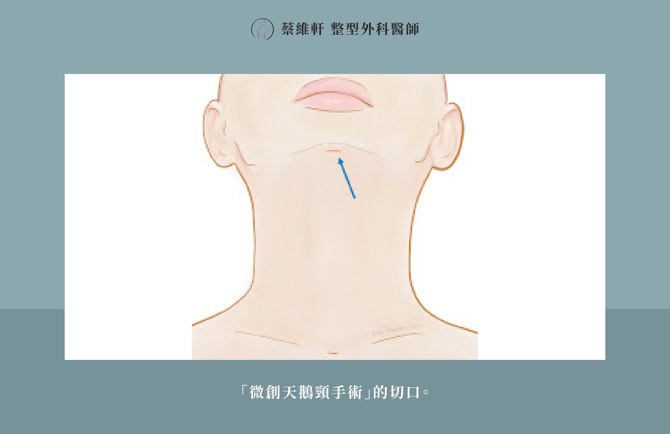 網站圖 微創天鵝頸手術P3 V1