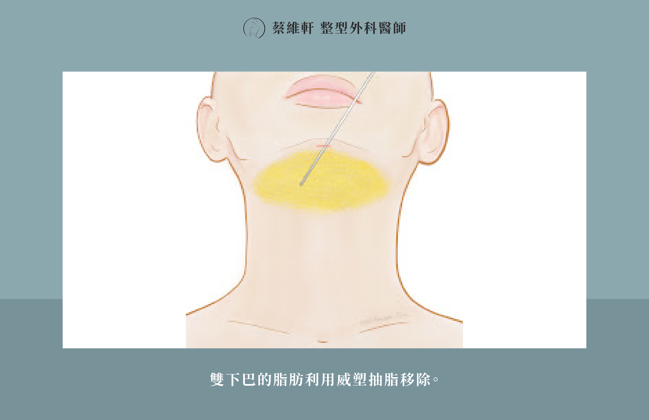 網站圖 微創天鵝頸手術P4 V1