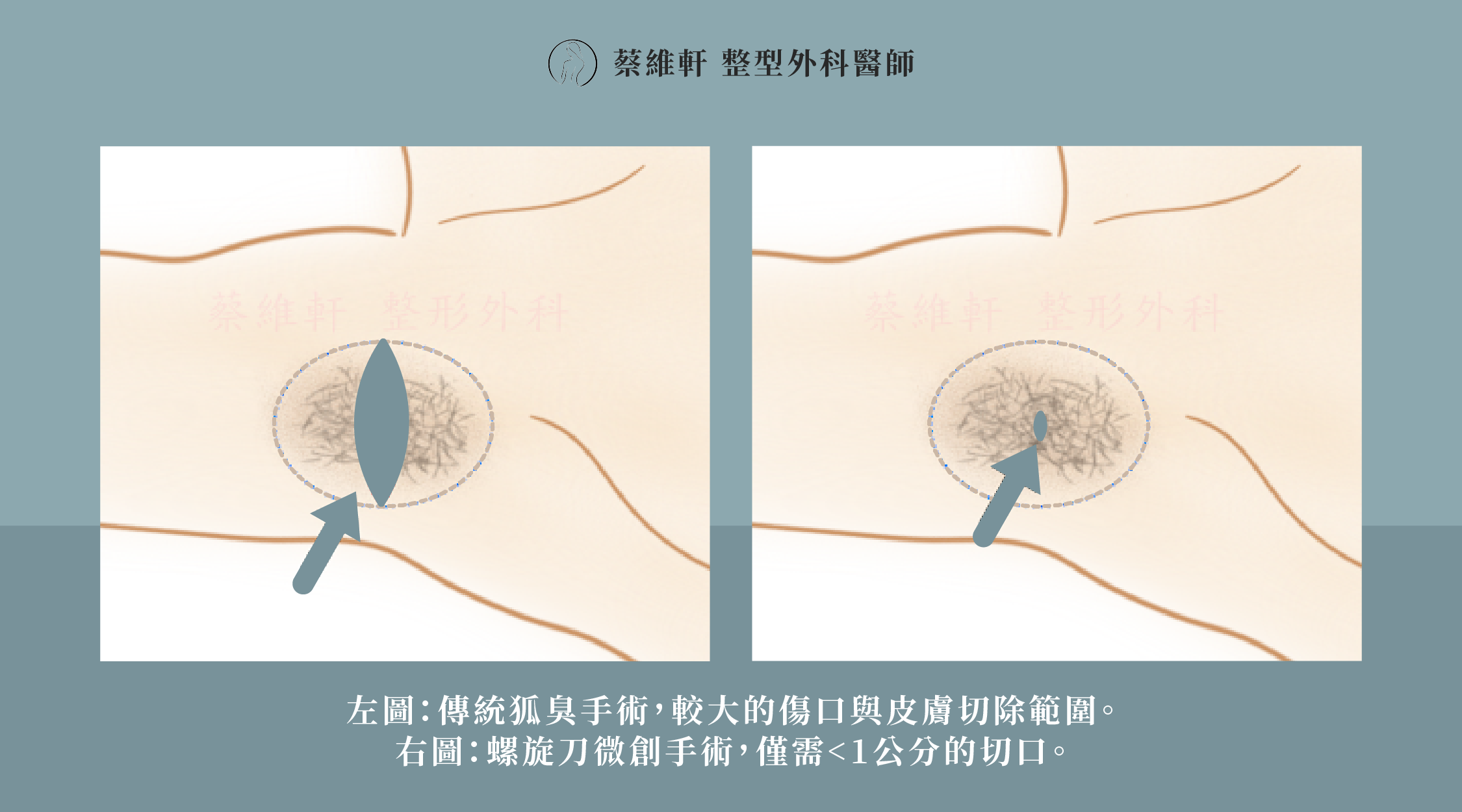 網站圖 狐臭 螺旋刀微創手術 P1 V1