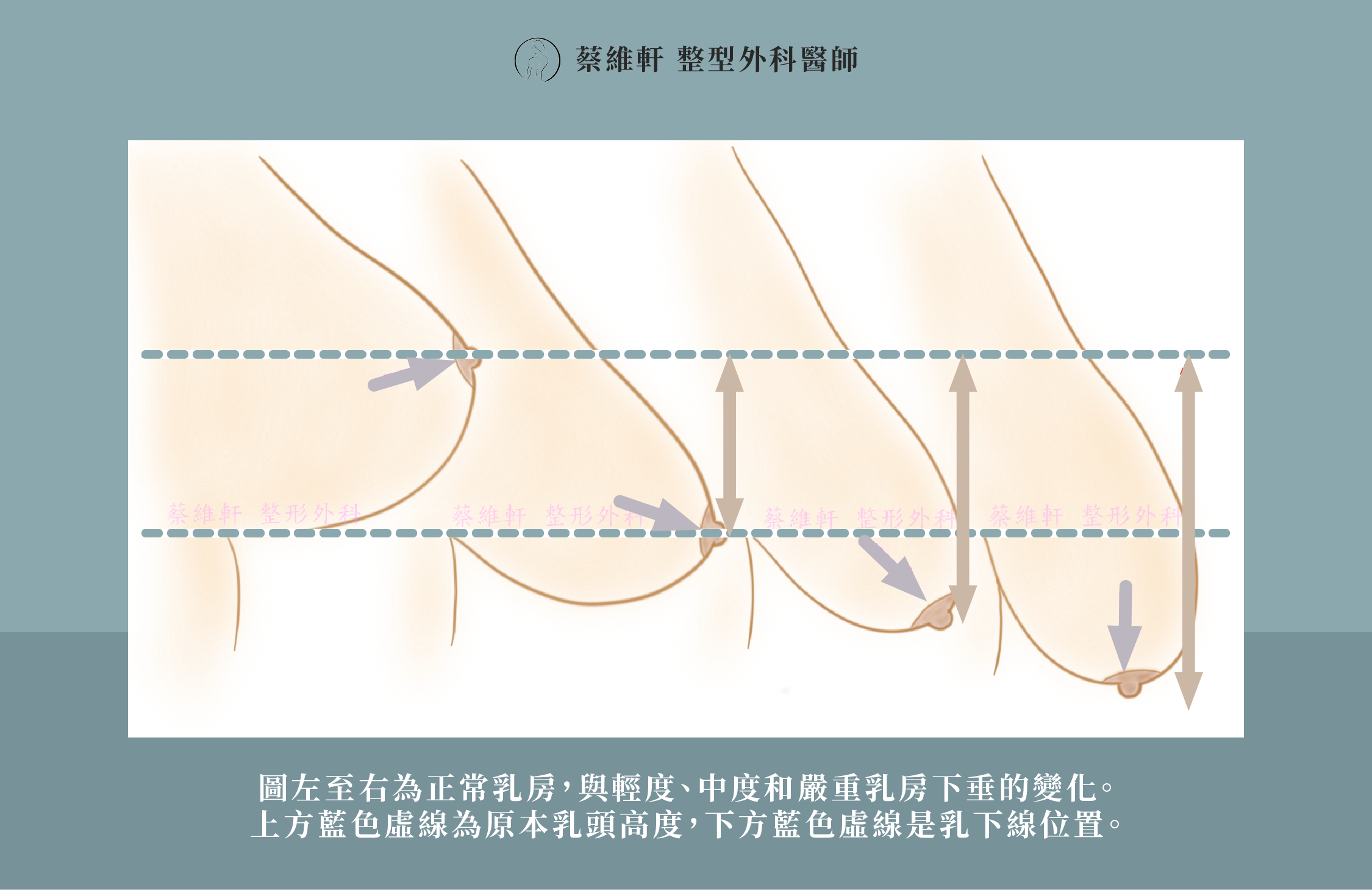 網站圖 乳房下垂及提乳手術解析P1 V2