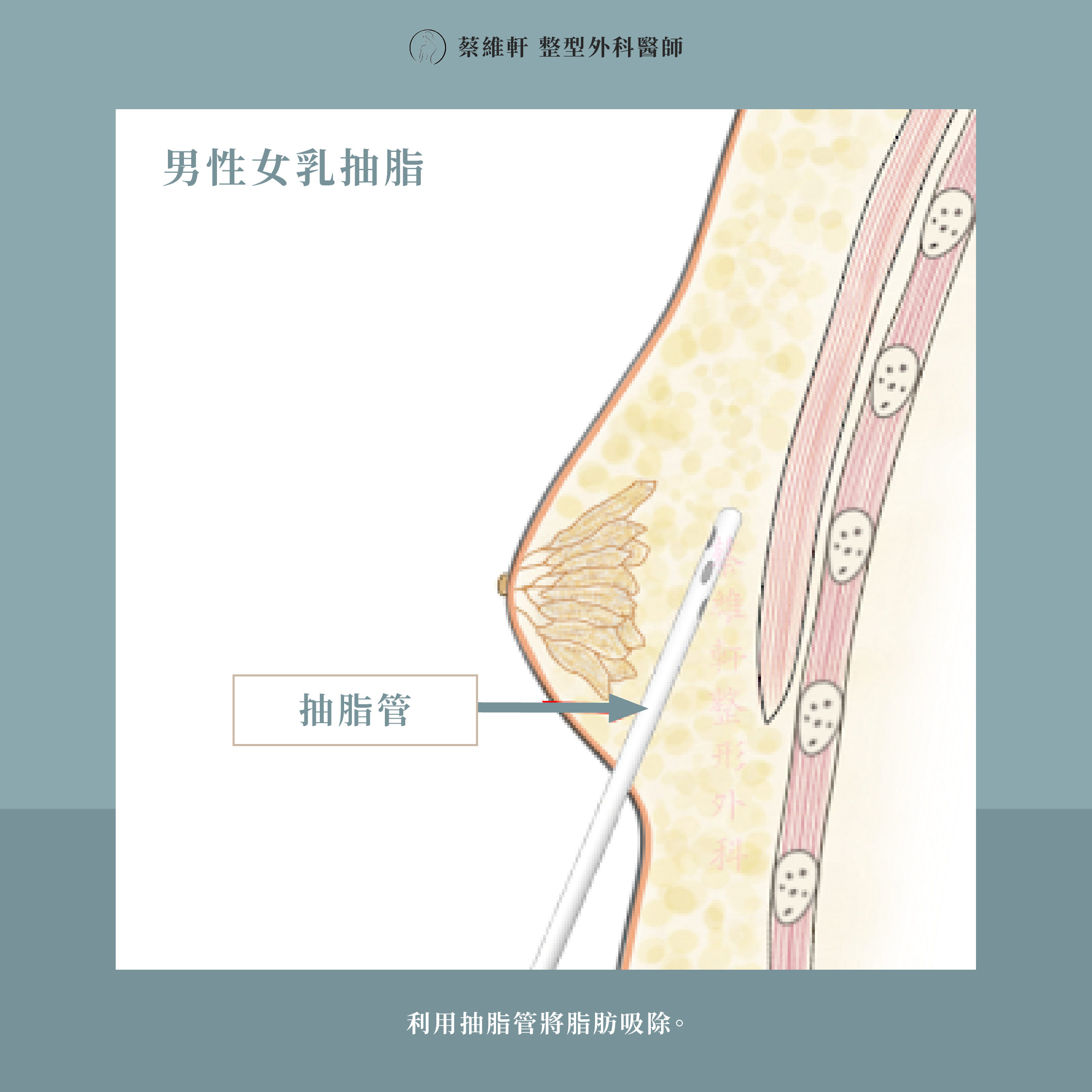 網站圖 男性女乳症成因與治療方P5 V1