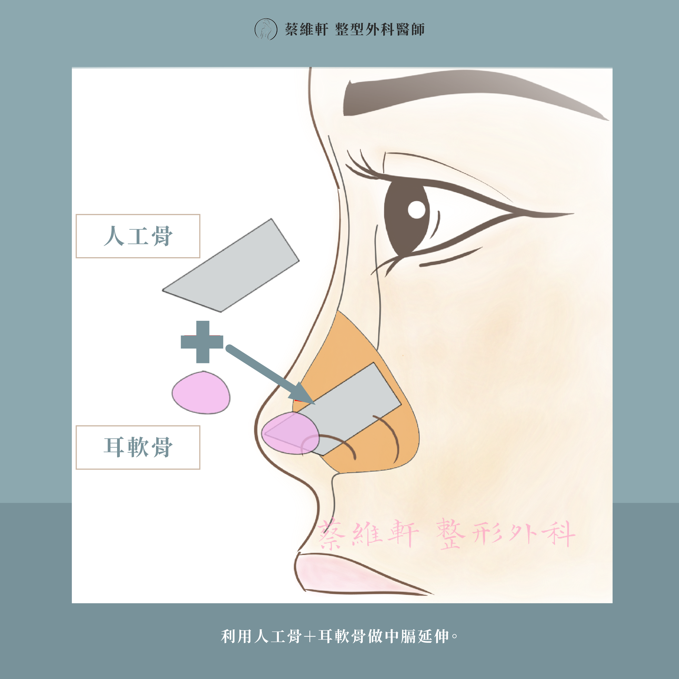 網站圖 結構式隆鼻 P3 V2