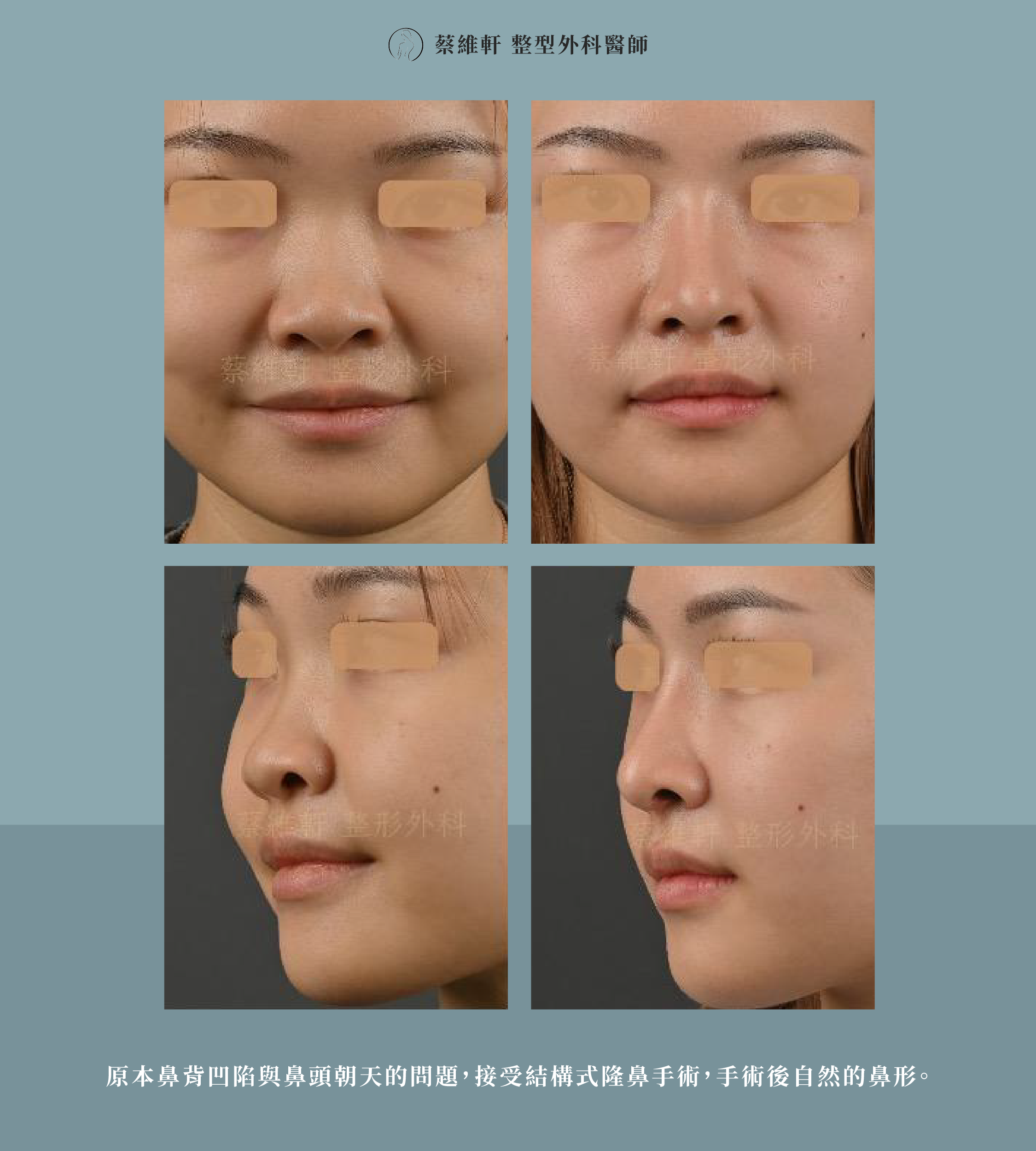 網站圖 結構式隆鼻 P6 V1