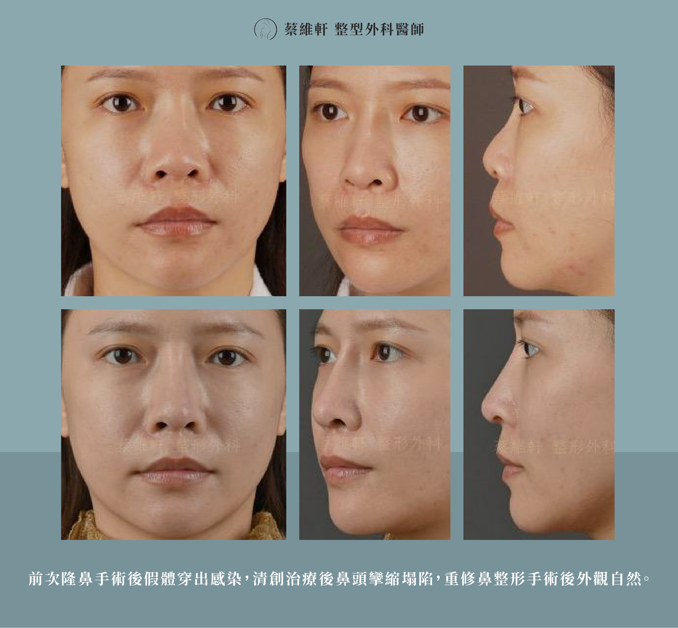 網站圖 結構式隆鼻 P7 V1