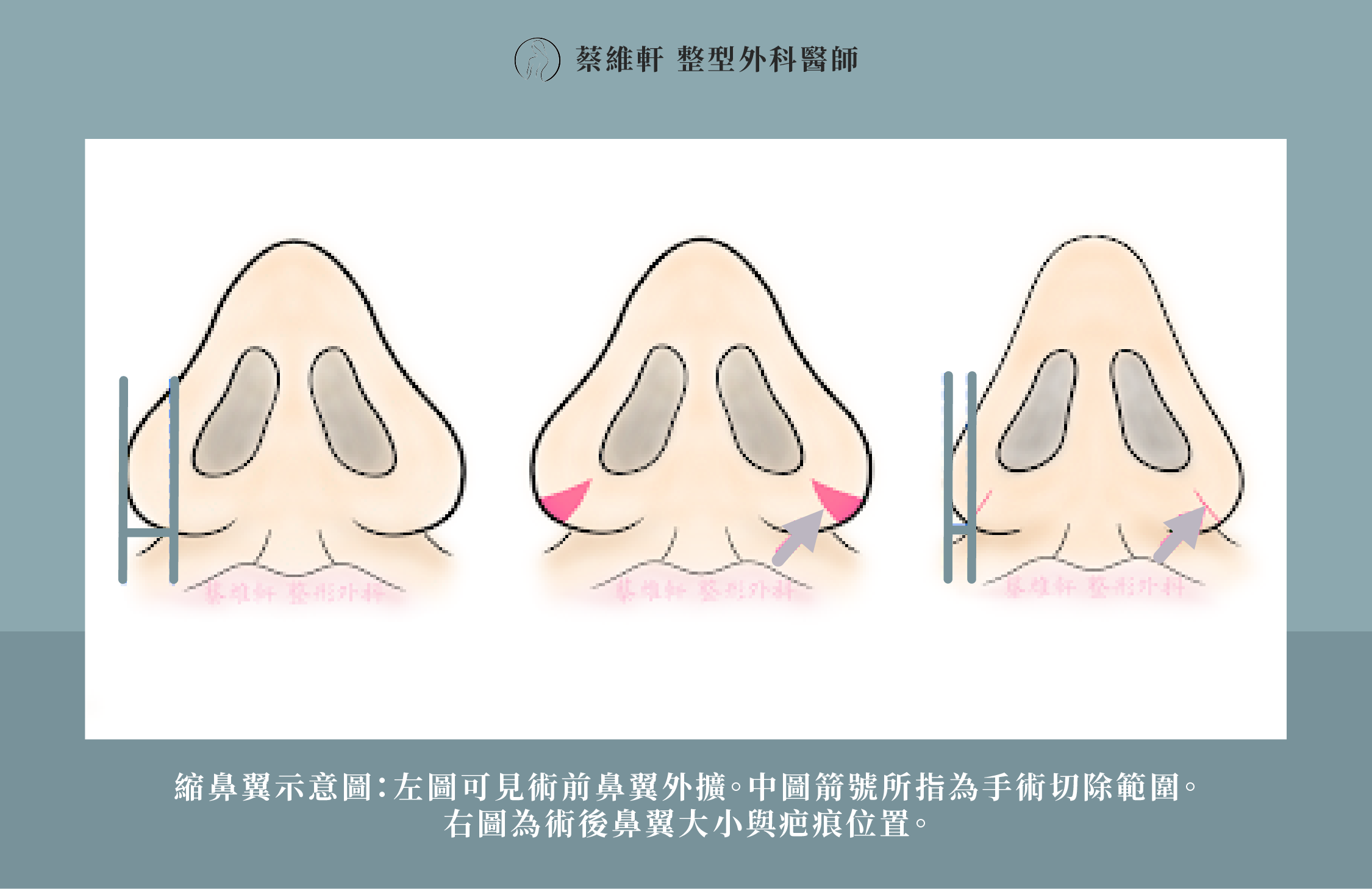 網站圖 縮鼻翼、縮鼻孔手術P2 V1