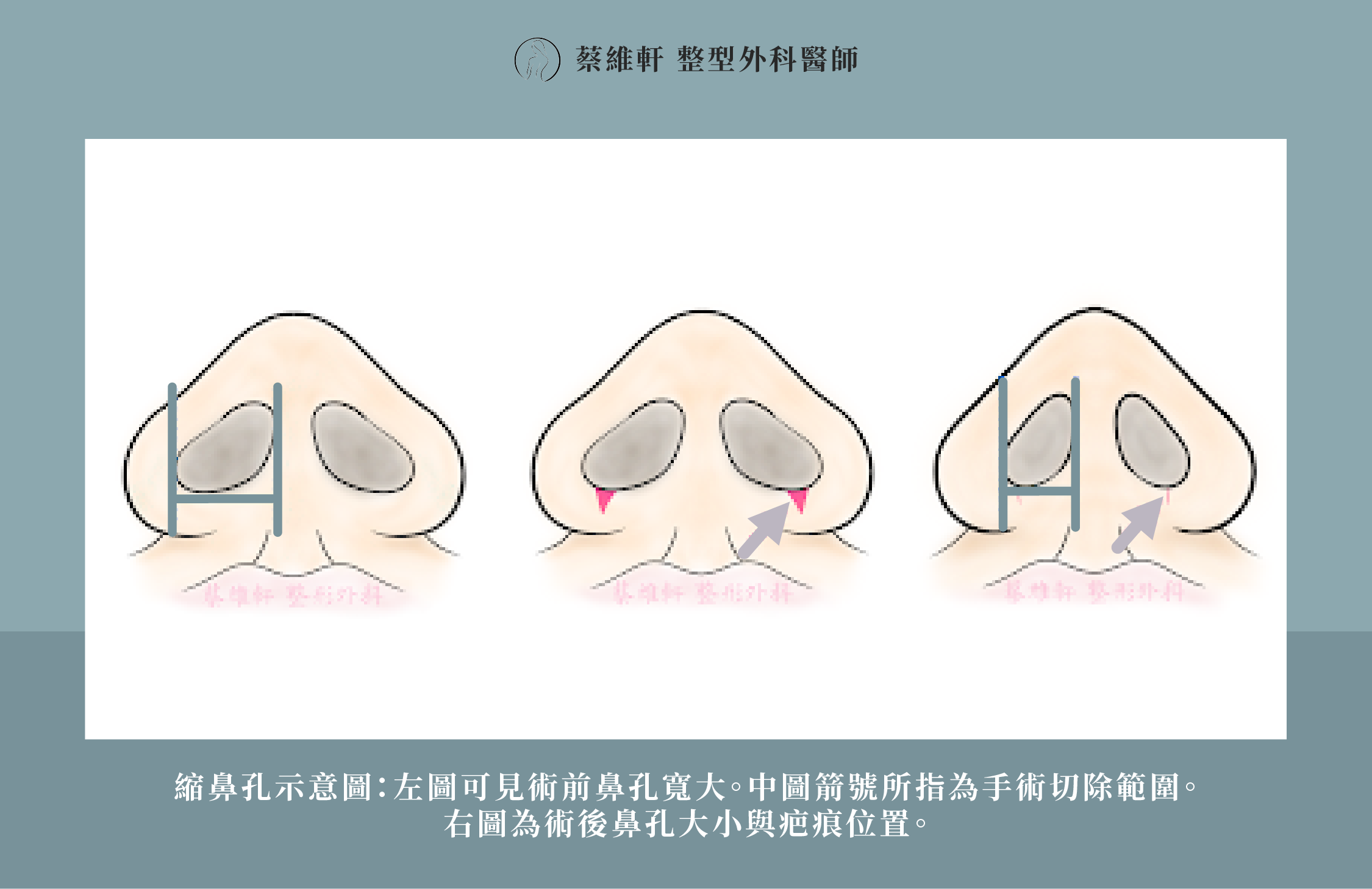 網站圖 縮鼻翼、縮鼻孔手術P4 V1