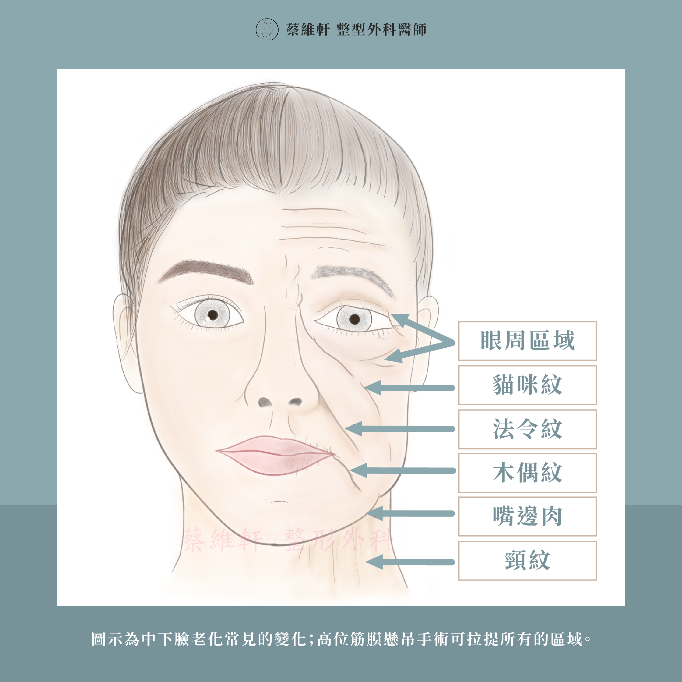 網站圖 臉部拉皮－高位筋膜懸吊術P2 V1